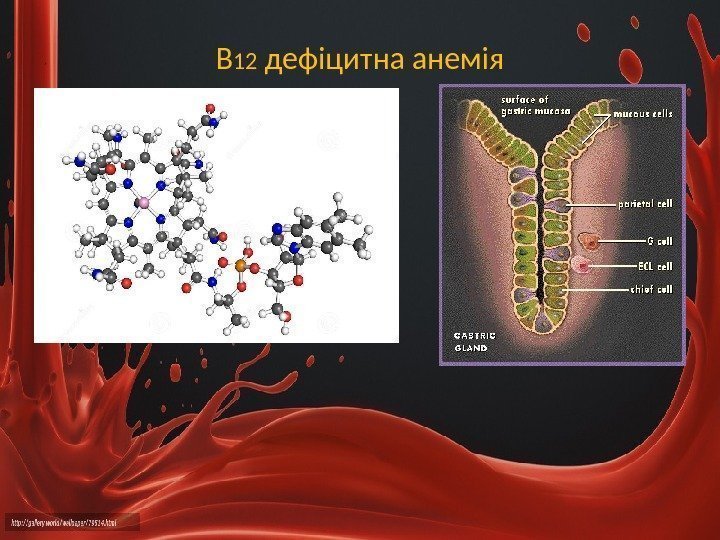 В 12 дефіцитна анемія 