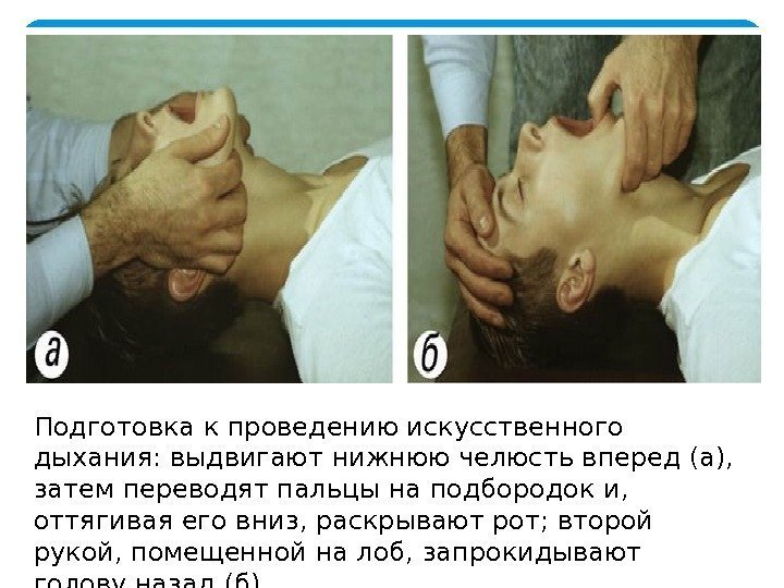 Подготовка к проведению искусственного дыхания: выдвигают нижнюю челюсть вперед (а),  затем переводят пальцы