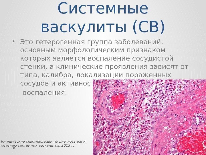 Системные васкулиты (СВ) • Это гетерогенная группа заболеваний,  основным морфологическим признаком которых является