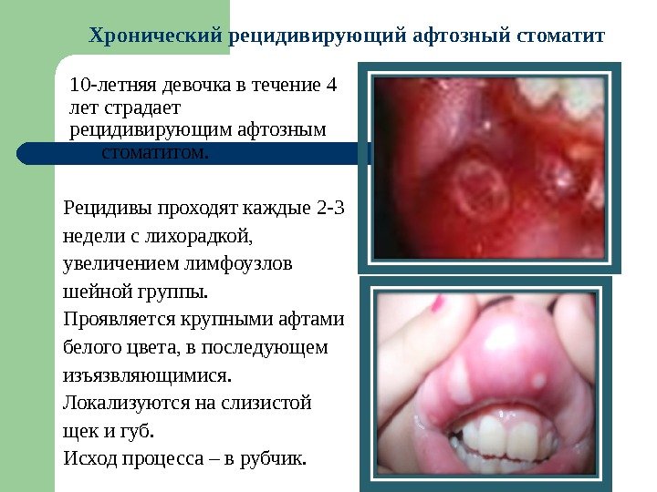 10 -летняя девочка в течение 4 лет страдает рецидивирующим афтозным стоматитом.  Рецидивы проходят