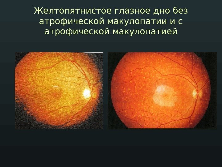 Желтопятнистое глазное дно без атрофической макулопатии и с атрофической макулопатией 
