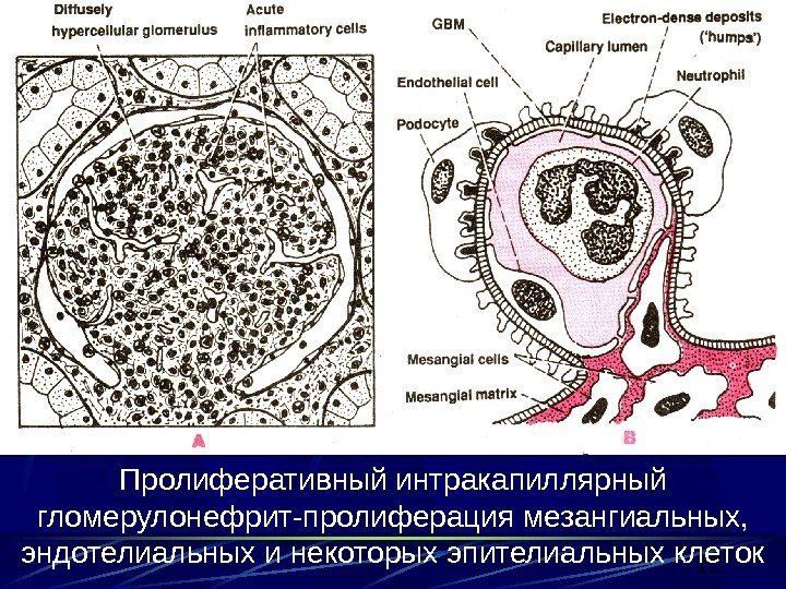 12 Пролиферативный интракапиллярный гломерулонефрит-пролиферация мезангиальных,  эндотелиальных и некоторых эпителиальных клеток 