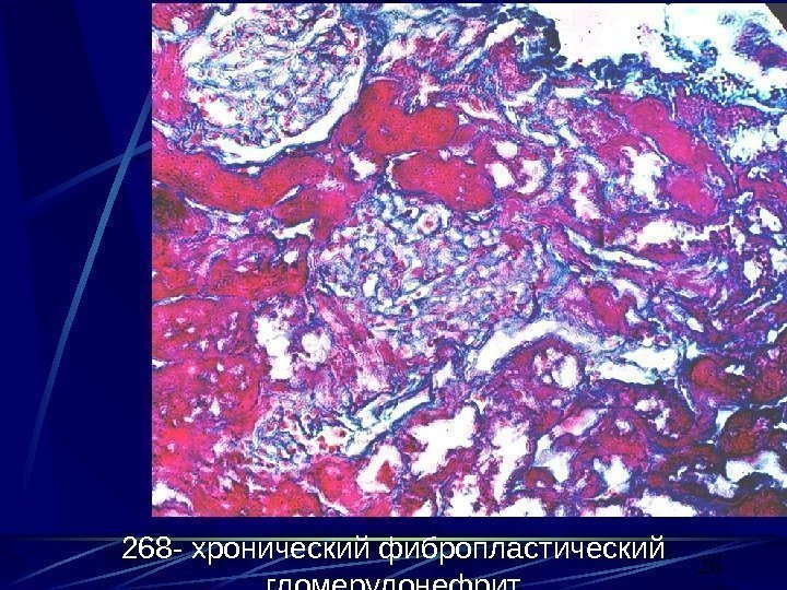 26268 - хронический фибропластический гломерулонефрит 
