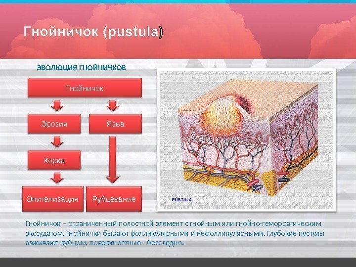 Гнойничок – ограниченный полостной элемент с гнойным или гнойно-геморрагическим  экссудатом.  Гнойнички бывают