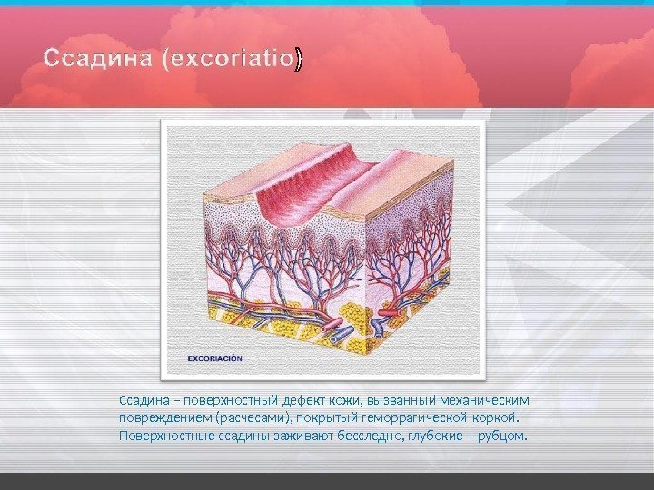 Ссадина – поверхностный дефект кожи,  вызванный механическим  повреждением (расчесами), покрытый геморрагической 