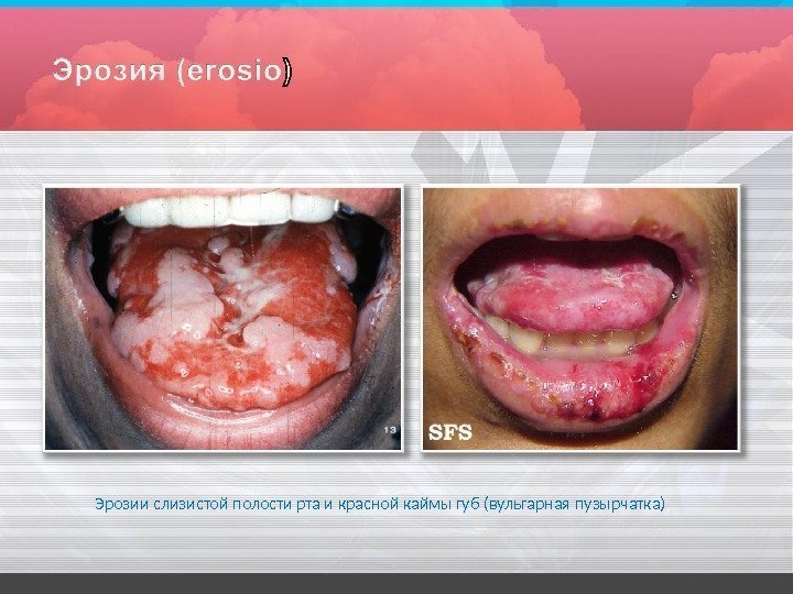 Эрозии слизистой полости рта и красной каймы губ (вульгарная  пузырчатка) 
