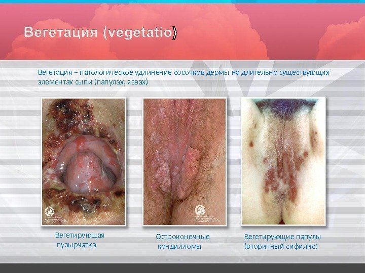 Вегетация – патологическое удлинение сосочков дермы на длительно существующих  элементах сыпи (папулах, 
