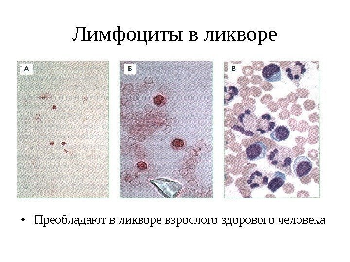 Лимфоциты в ликворе • Преобладают в ликворе взрослого здорового человека 