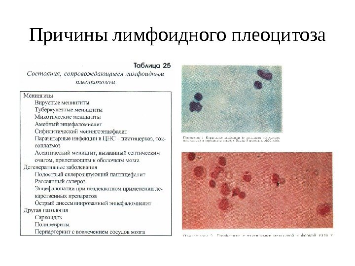 Причины лимфоидного плеоцитоза 