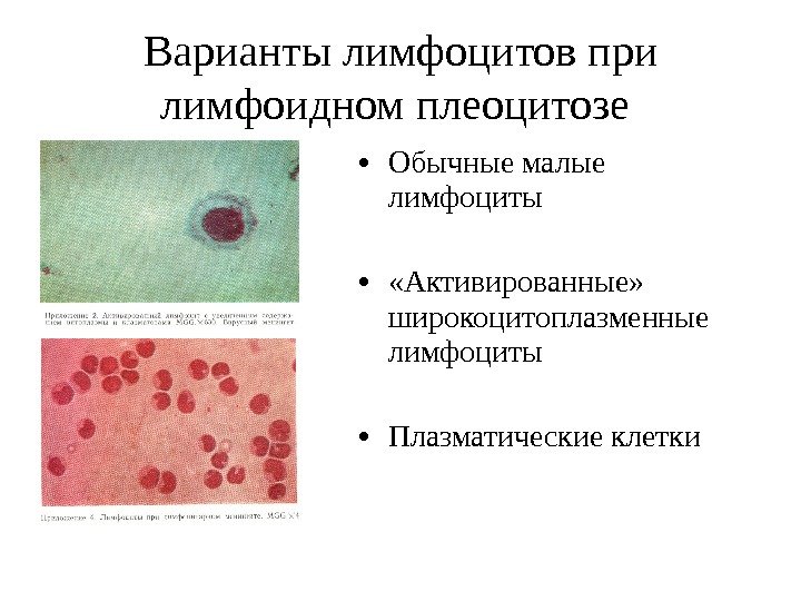 Варианты лимфоцитов при лимфоидном плеоцитозе  • Обычные малые лимфоциты •  «Активированные» 