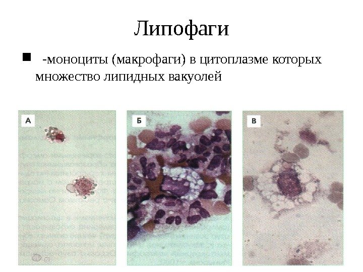 Липофаги -моноциты (макрофаги) в цитоплазме которых множество липидных вакуолей 