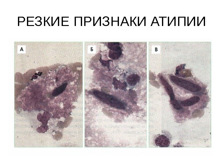 РЕЗКИЕ ПРИЗНАКИ АТИПИИ 