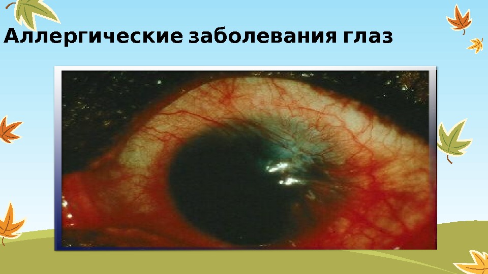   Аллергические заболевания глаз  