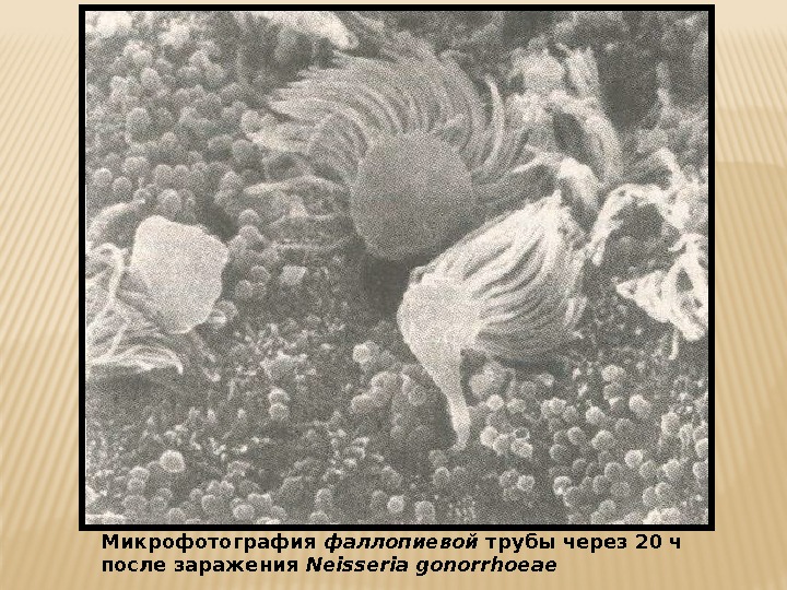 Микрофотография фаллопиевой трубы через 20 ч после заражения Neisseria gonorrhoeae  