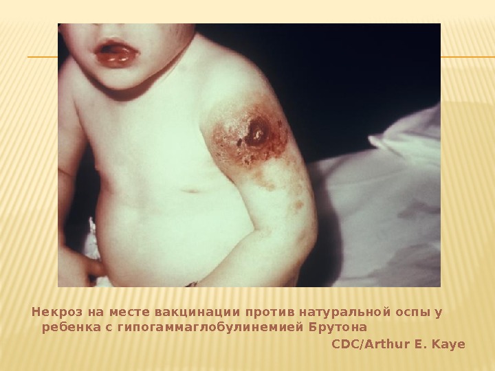 Некроз на месте вакцинации против натуральной оспы у ребенка с гипогаммаглобулинемией Брутона  