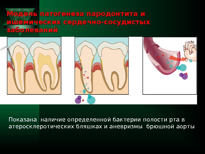 Модель патогенеза пародонтита и  ишемических сердечно-сосудистых заболеваний Показана наличие определенной бактерии полости рта