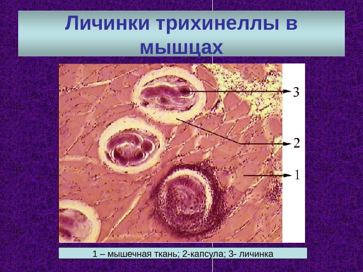 Личинки трихинеллы в мышцах 1 – мышечная ткань; 2 -капсула; 3 - личинка 