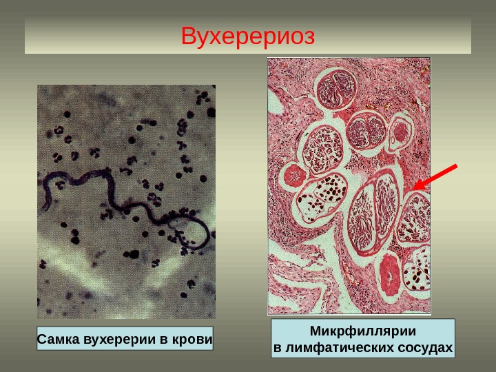 Вухерериоз Самка вухерерии в крови Микрфиллярии в лимфатических сосудах 