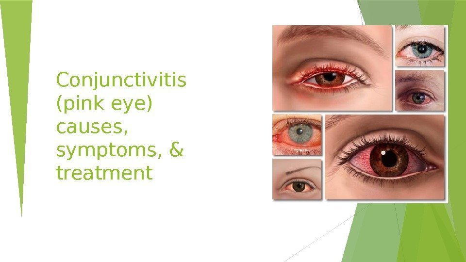 Conjunctivitis (pink eye) causes,  symptoms, & treatment   