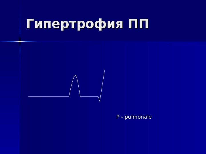   Гипертрофия ПП Р - pulmonale 