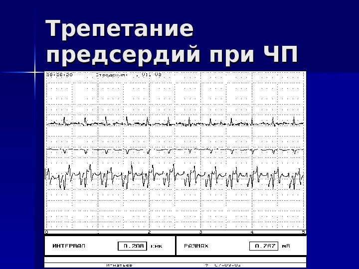   Трепетание предсердий при ЧП ЭГЭГ 