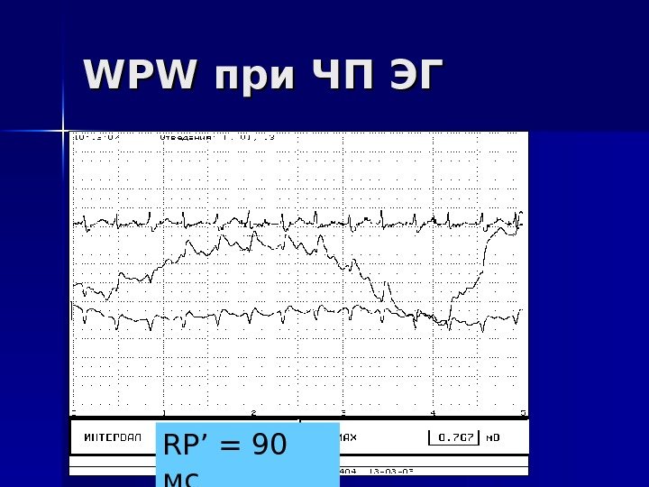   WPW при ЧП ЭГ RP’ = 90 мс 