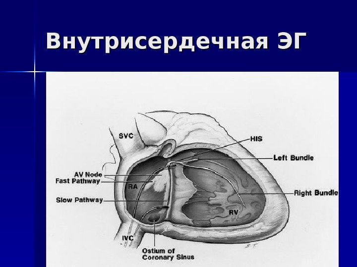   Внутрисердечная ЭГ 