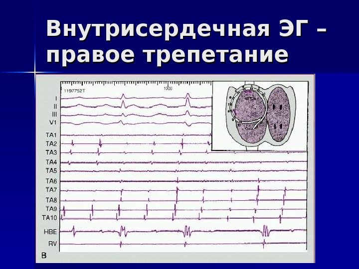   Внутрисердечная ЭГ – правое трепетание 