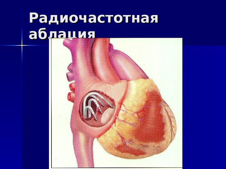   Радиочастотная аблация 