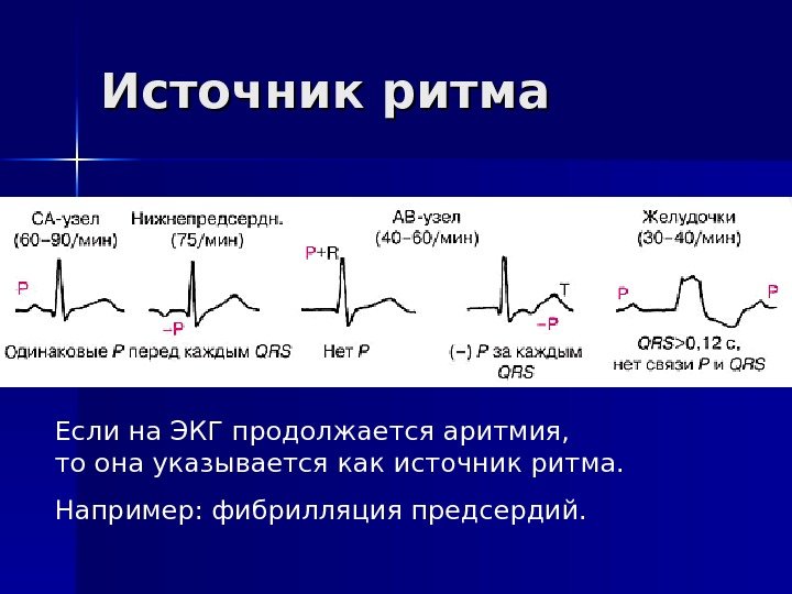   Источник ритма Если на ЭКГ продолжается аритмия,  то она указывается как