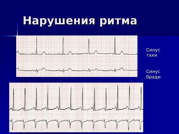   Нарушения ритма Синус тахи Синус бради 