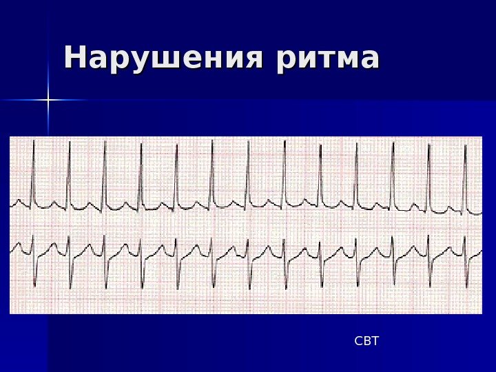   Нарушения ритма СВТ 