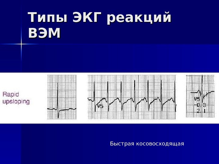   Типы ЭКГ реакций ВЭМВЭМ Быстрая косовосходящая 