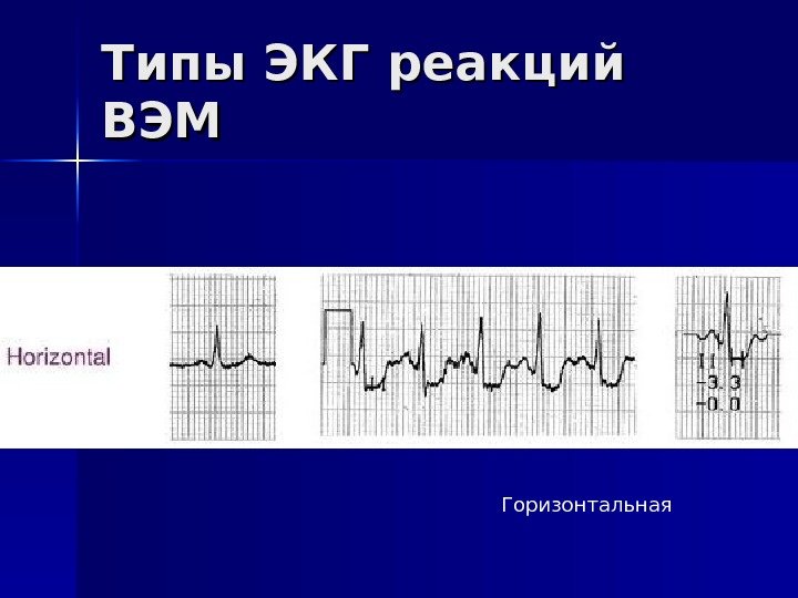   Типы ЭКГ реакций ВЭМВЭМ Горизонтальная 