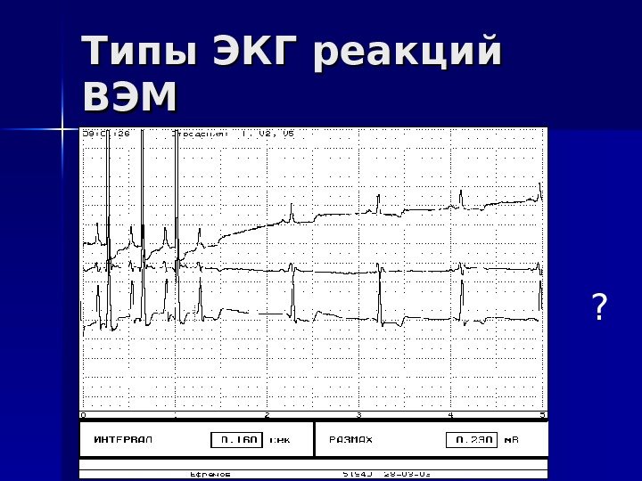   Типы ЭКГ реакций ВЭМВЭМ ? 