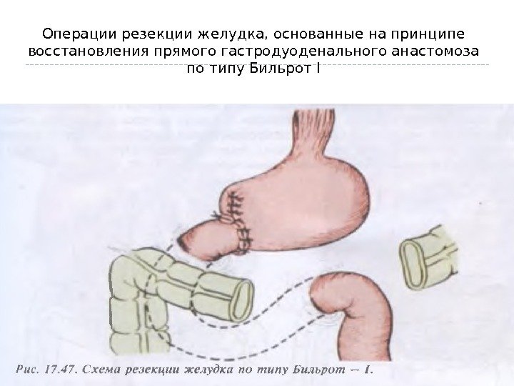 Операции резекции желудка, основанные на принципе восстановления прямого гастродуоденального анастомоза по типу Бильрот I