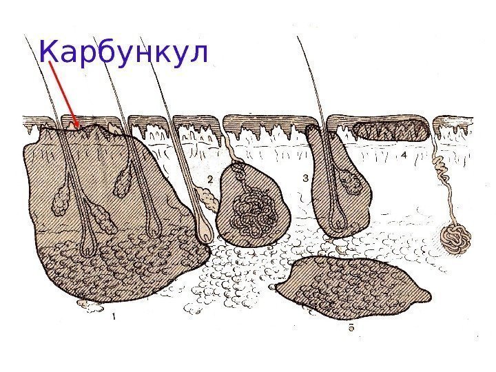   фурункул. Карбункул 