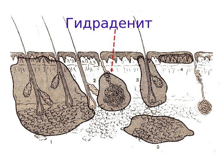   фурункул. Гидраденит 