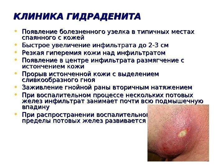   КЛИНИКА ГИДРАДЕНИТА • Появление болезненного узелка в типичных местах спаянного с кожей
