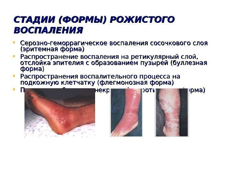   СТАДИИ (ФОРМЫ) РОЖИСТОГО ВОСПАЛЕНИЯ • Серозно-геморрагическое воспаления сосочкового слоя (эритемная форма) •