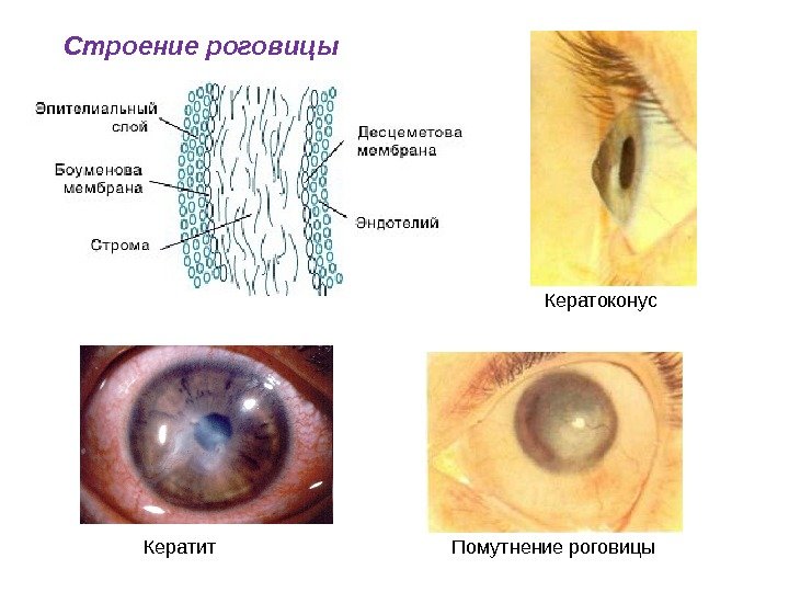 Строение роговицы Кератоконус Кератит Помутнение роговицы 