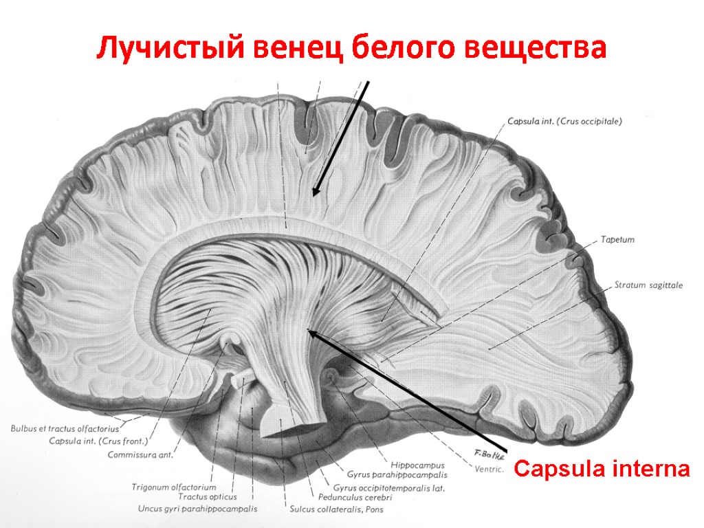 Внутренняя капсула анатомия клиническая картина поражения