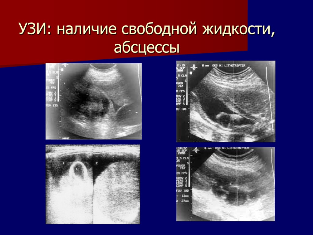 Свободная жидкость 10 мм