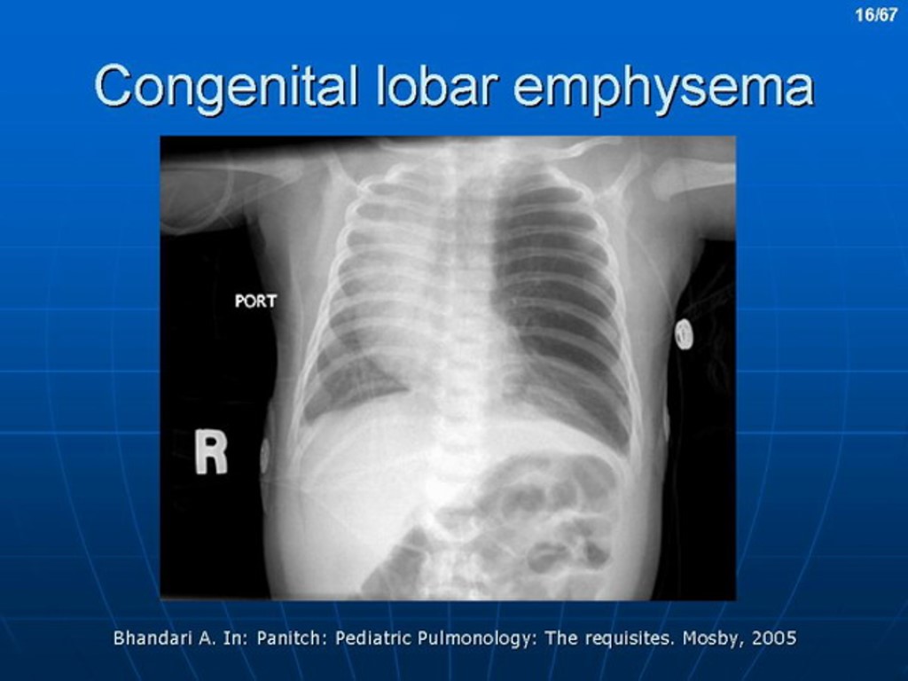 Respiratory disorders in newborns. The occurrence of RD