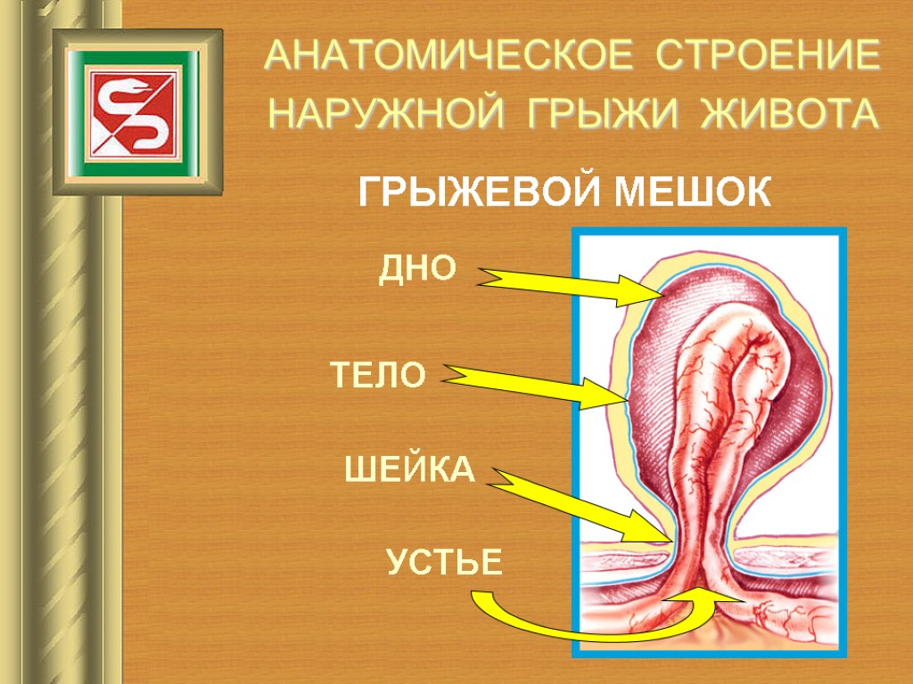 Грыжевой мешок. Строение стенки грыжевого мешка. Грыжевой мешок строение.