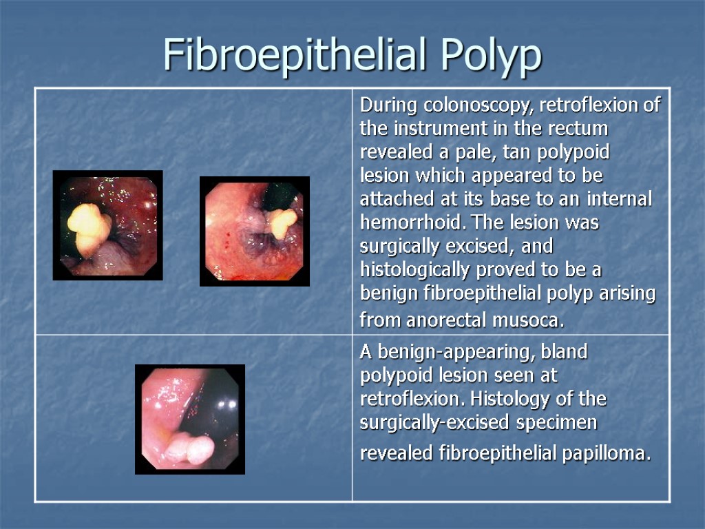 fibroepithelial papilloma polyp