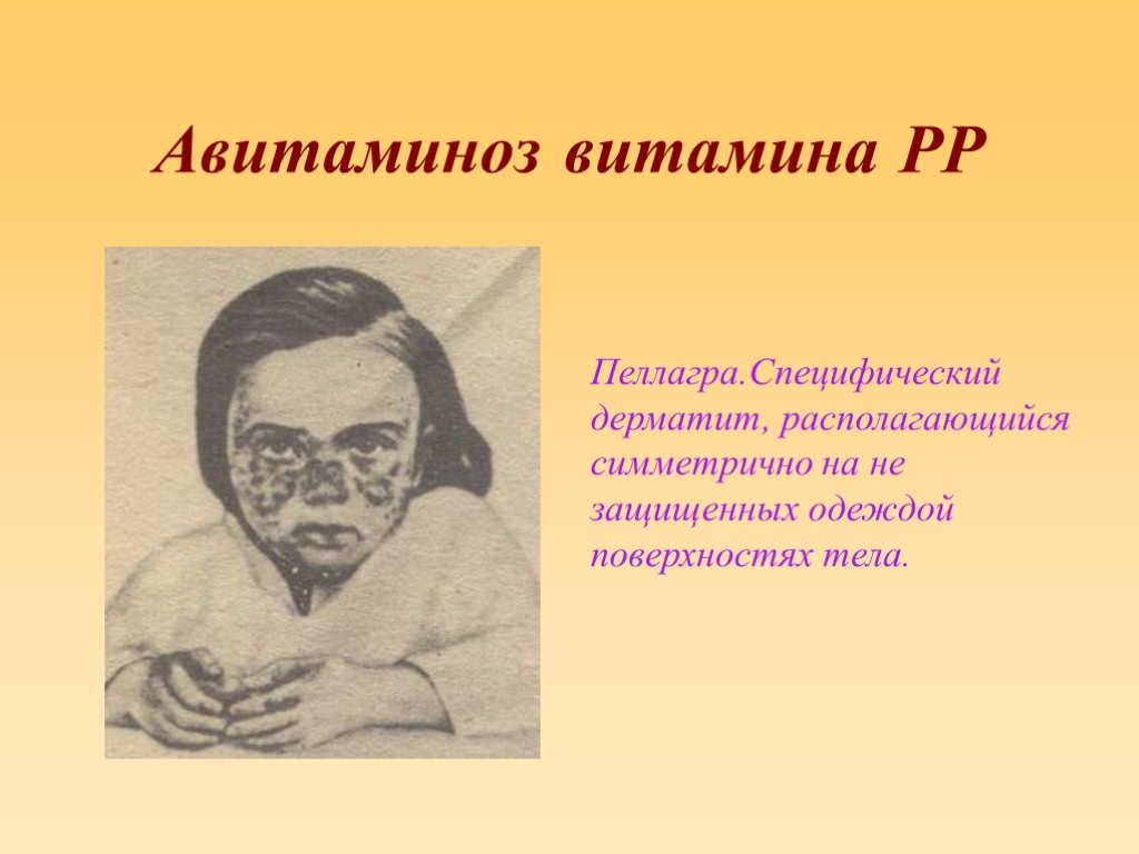 Авитаминоз. Авитаминов витамина рр. Витамин рр симптомы авитаминоза.