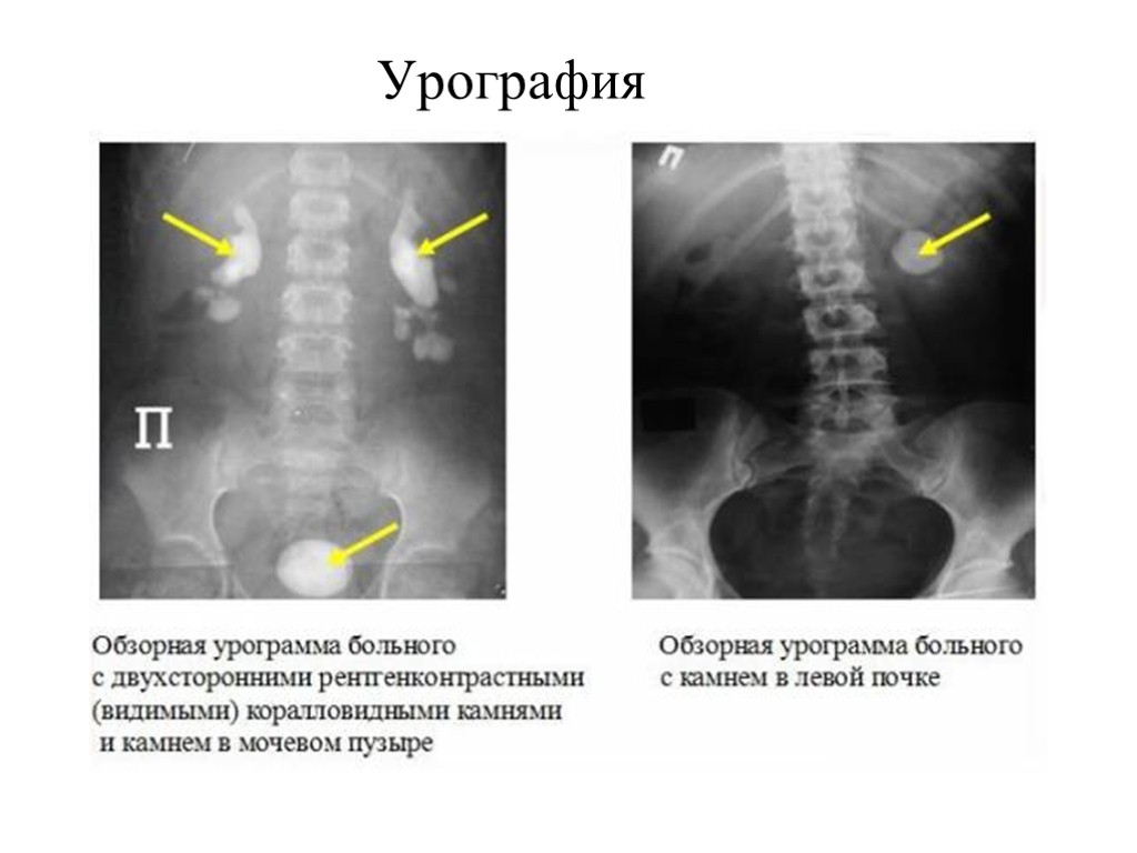 Урография почек. Экскреторная урография почек мочекаменная болезнь. Обзорная рентгенограмма органов мочевой системы. Обзорная рентгенография почек. Мочекаменная болезнь экскреторная урография.