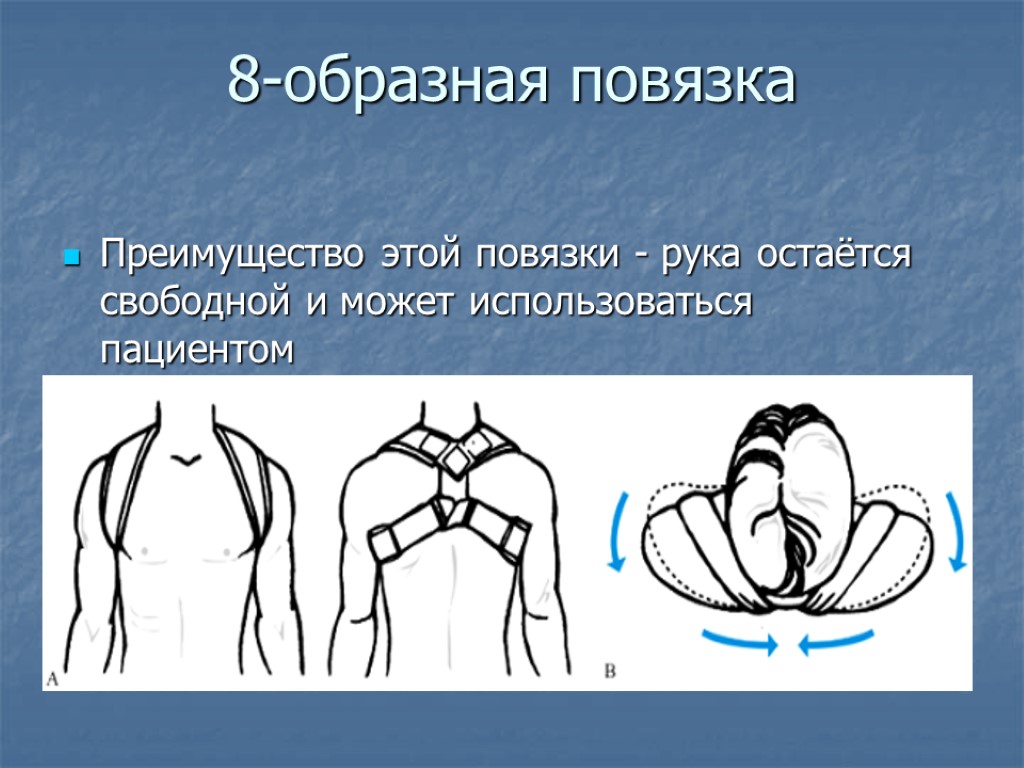 >8-образная повязка Преимущество этой повязки - рука остаётся свободной и может использоваться пациентом