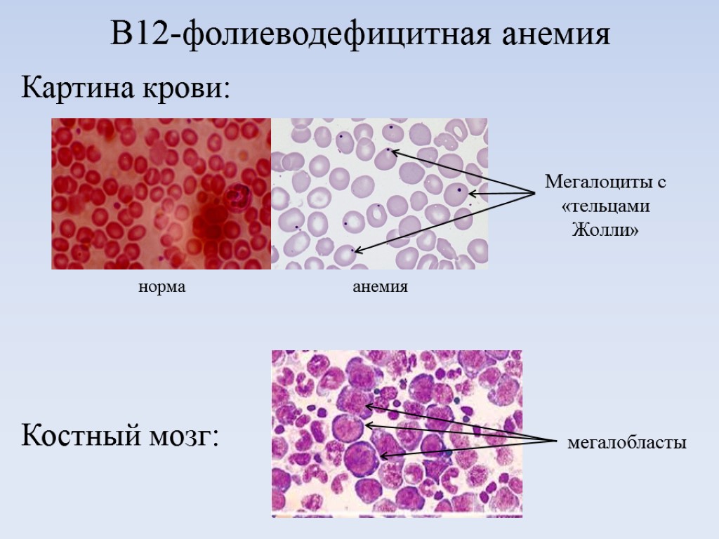 Картина крови при в12 дефицитной анемии периферической